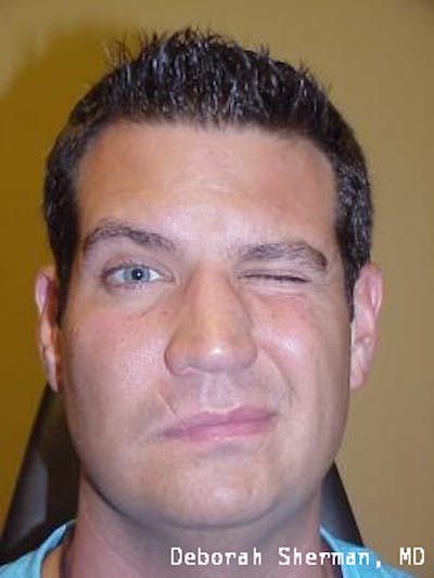 Hemifacial Spasm Before & After Gallery - Patient 317136 - Image 1