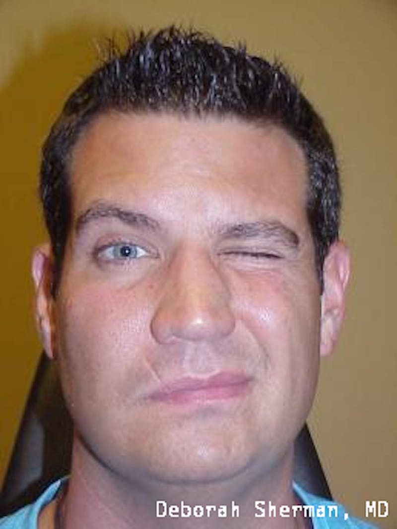 Hemifacial Spasm Before & After Gallery - Patient 317136 - Image 1