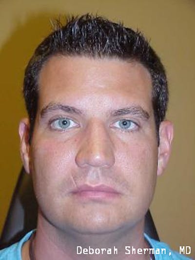 Hemifacial Spasm Before & After Gallery - Patient 317136 - Image 2
