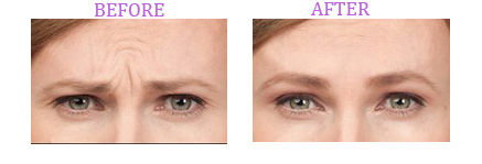 botox results