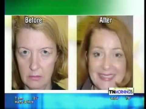 eyelid lift patient results