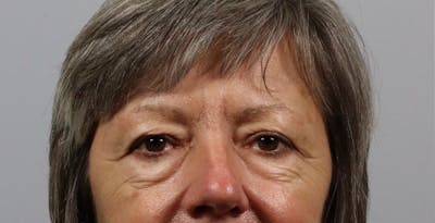 Eyelid Lift/Blepharoplasty Before & After Gallery - Patient 361603 - Image 1
