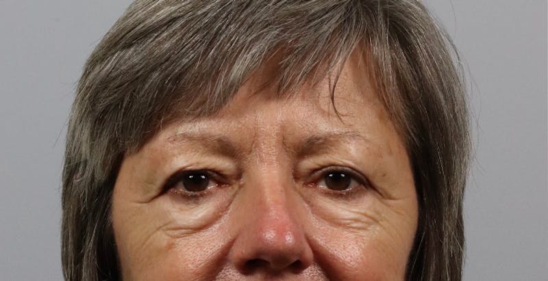 Eyelid Lift/Blepharoplasty Before & After Gallery - Patient 361603 - Image 1