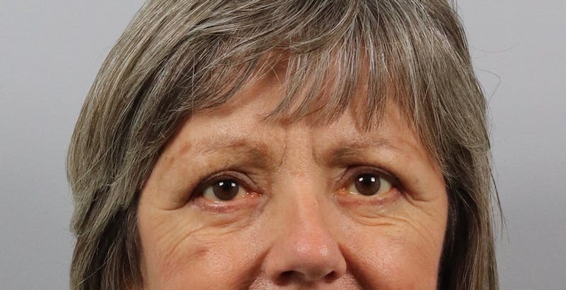 Eyelid Lift/Blepharoplasty Before & After Gallery - Patient 361603 - Image 2