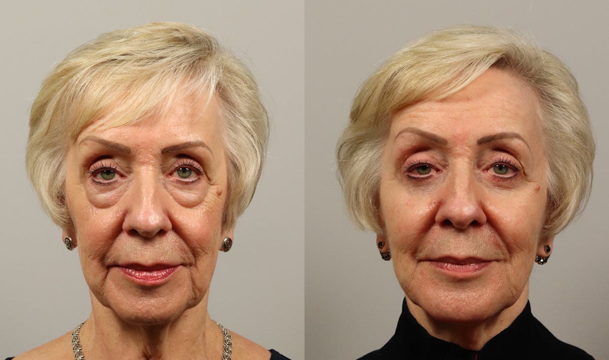 Eyelid Lift/Blepharoplasty Before & After Gallery - Patient 449798 - Image 1