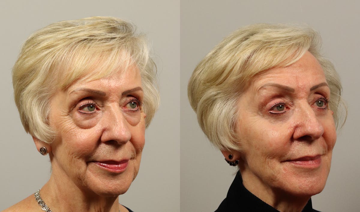 Eyelid Lift/Blepharoplasty Before & After Gallery - Patient 449798 - Image 2