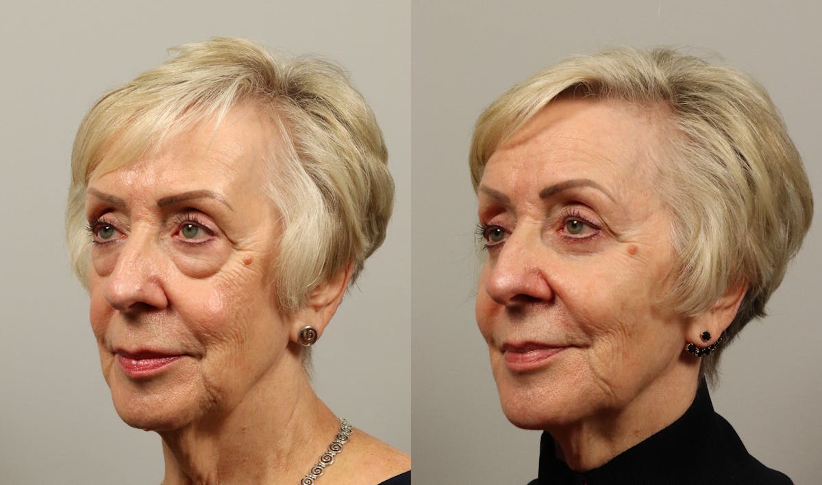 Eyelid Lift/Blepharoplasty Before & After Gallery - Patient 449798 - Image 3