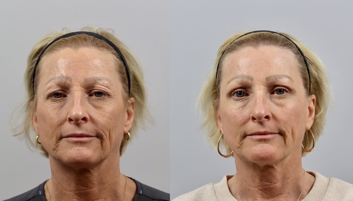 Eyelid Lift/Blepharoplasty Before & After Gallery - Patient 401102 - Image 1