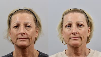 Eyelid Lift/Blepharoplasty Before & After Gallery - Patient 401102 - Image 1