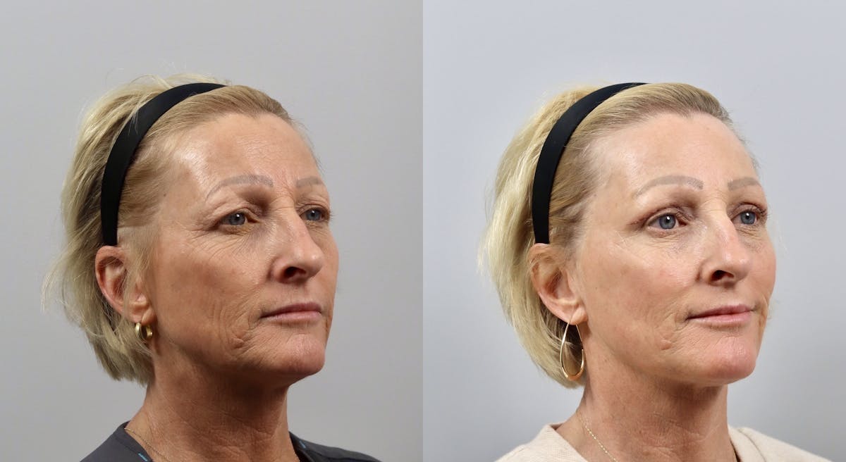 Eyelid Lift/Blepharoplasty Before & After Gallery - Patient 401102 - Image 2