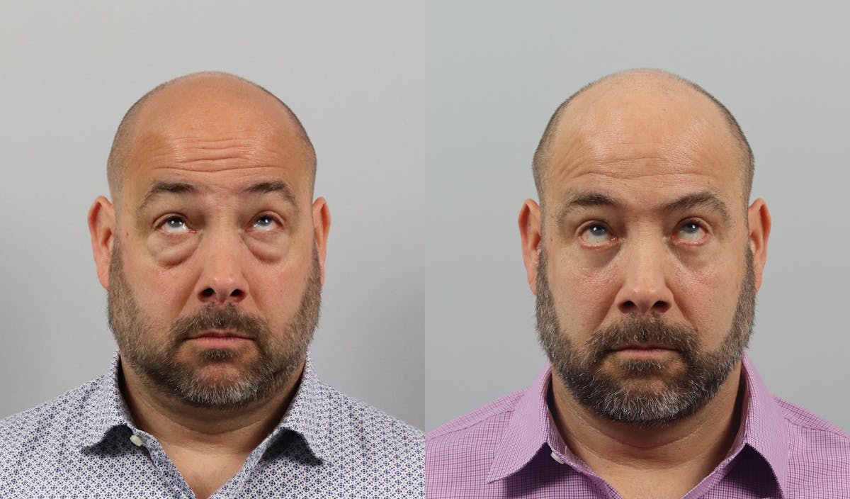 Eyelid Lift/Blepharoplasty Before & After Gallery - Patient 207708 - Image 2