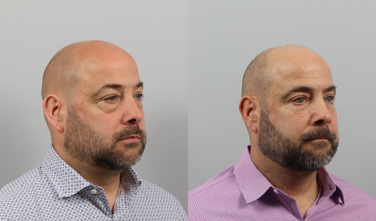 Eyelid Lift/Blepharoplasty Before & After Gallery - Patient 207708 - Image 3