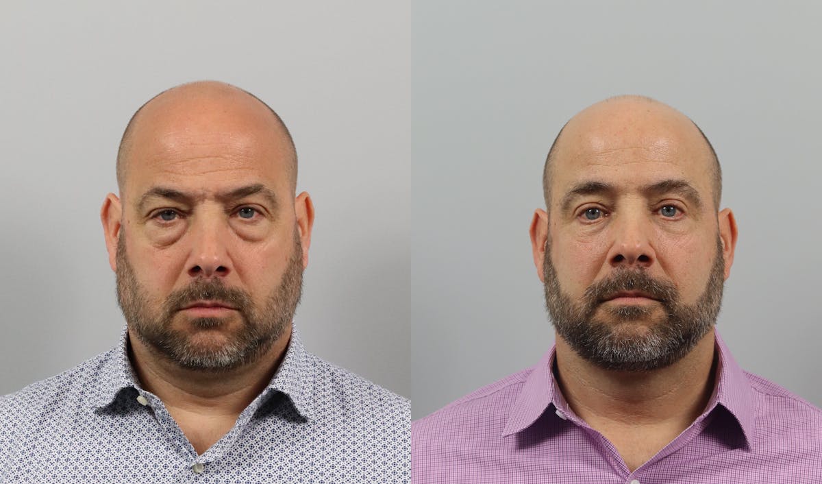 Eyelid Lift/Blepharoplasty Before & After Gallery - Patient 207708 - Image 1
