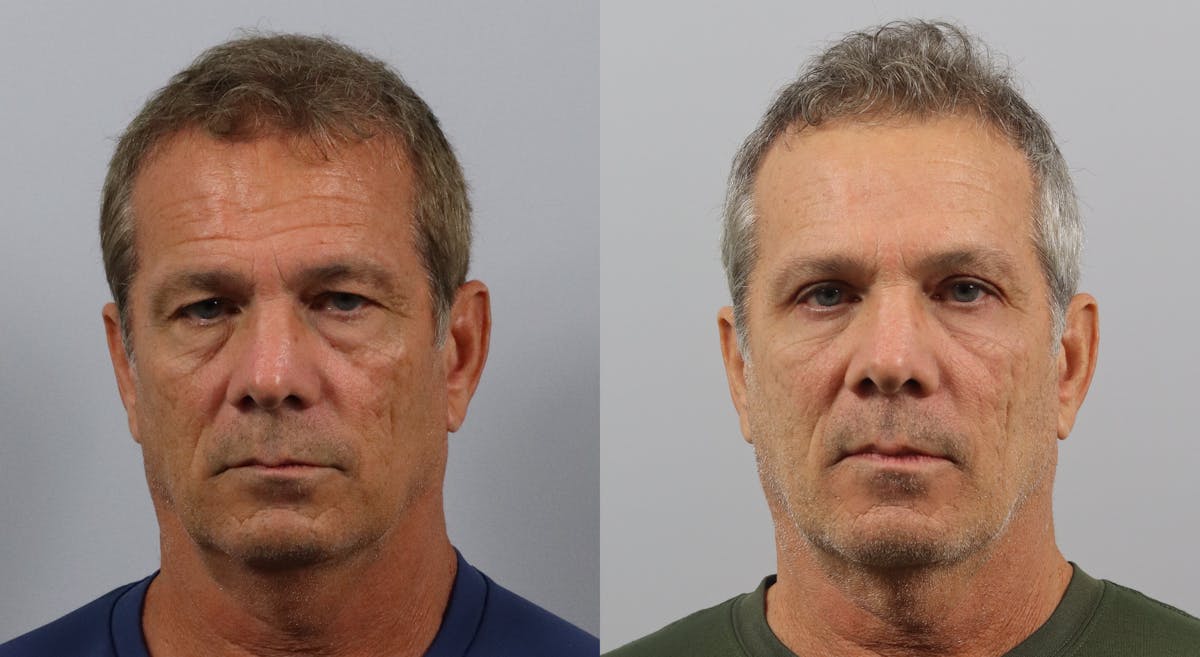 Eyelid Lift/Blepharoplasty Before & After Gallery - Patient 314683 - Image 1