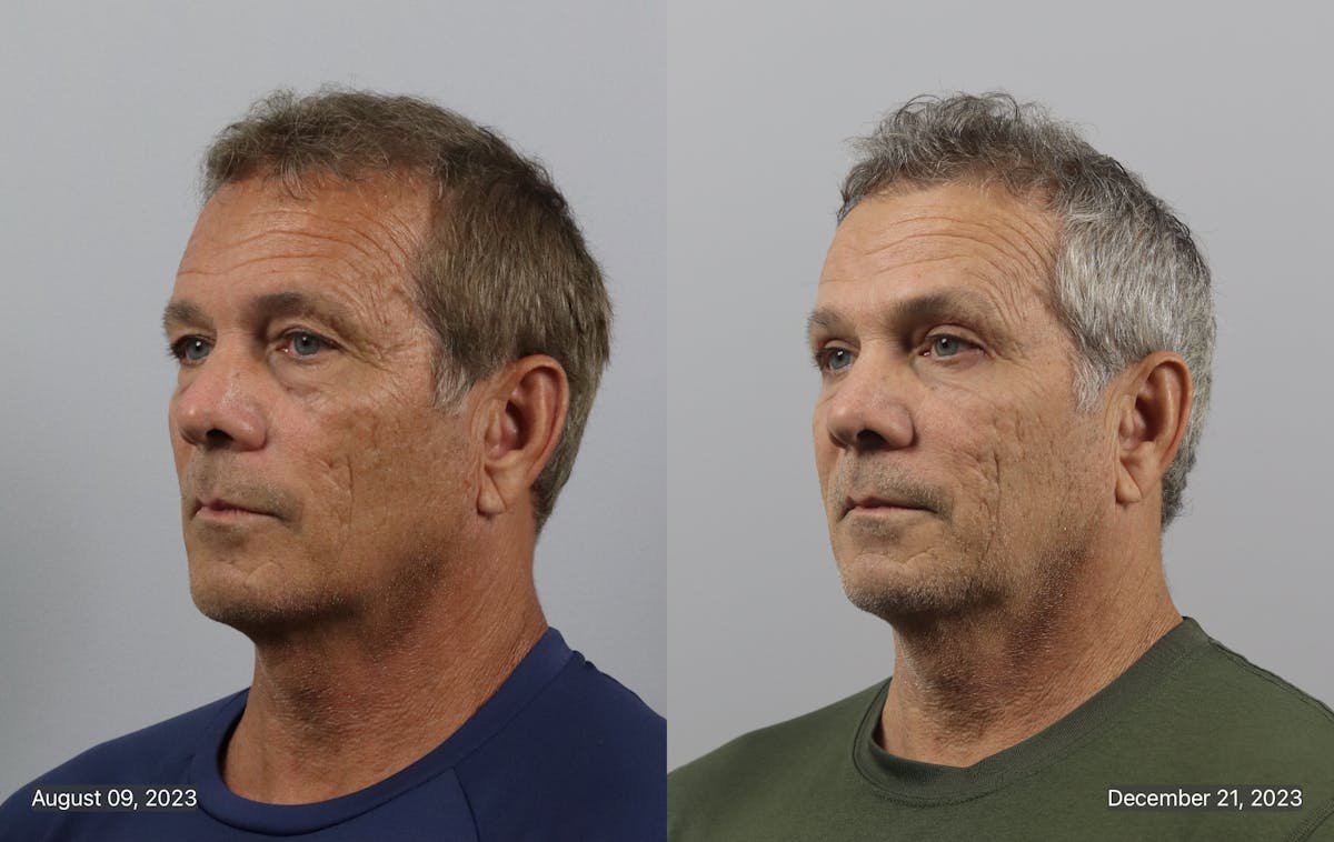 Eyelid Lift/Blepharoplasty Before & After Gallery - Patient 314683 - Image 2