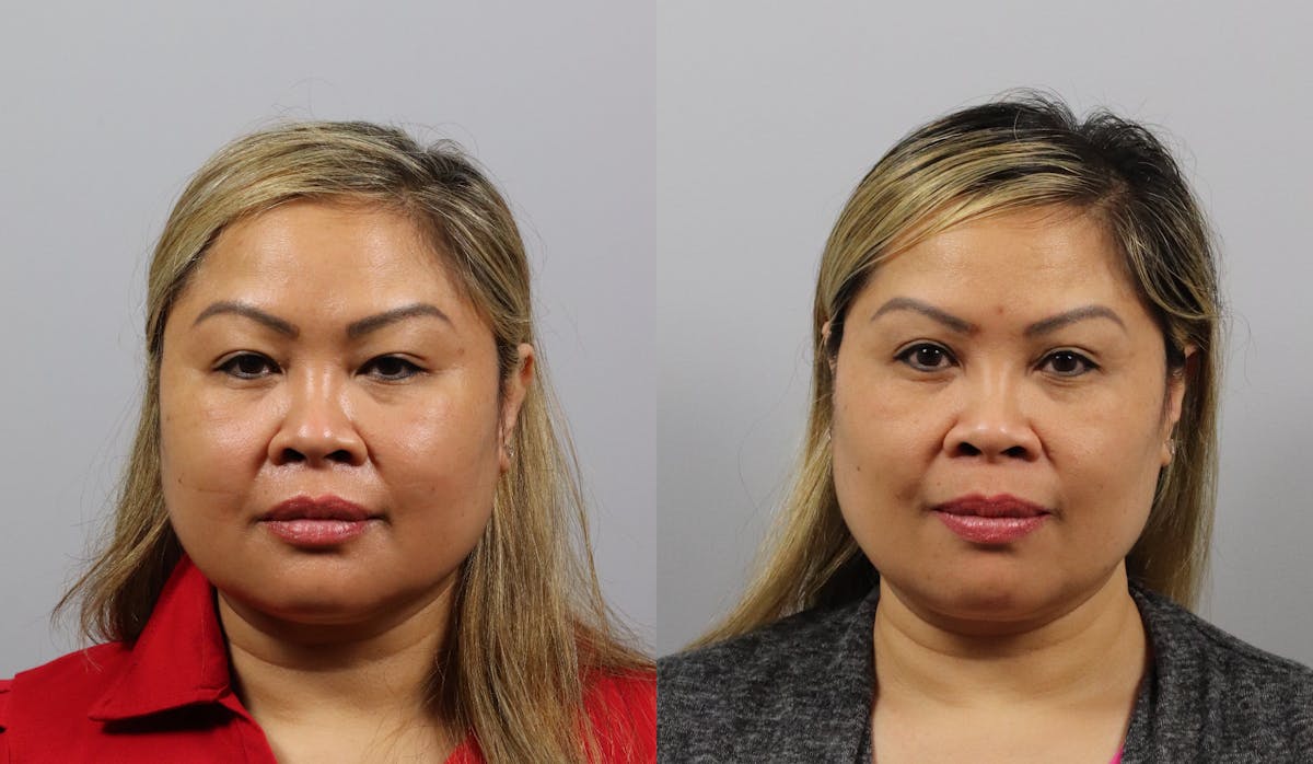 Eyelid Lift/Blepharoplasty Before & After Gallery - Patient 365138 - Image 1
