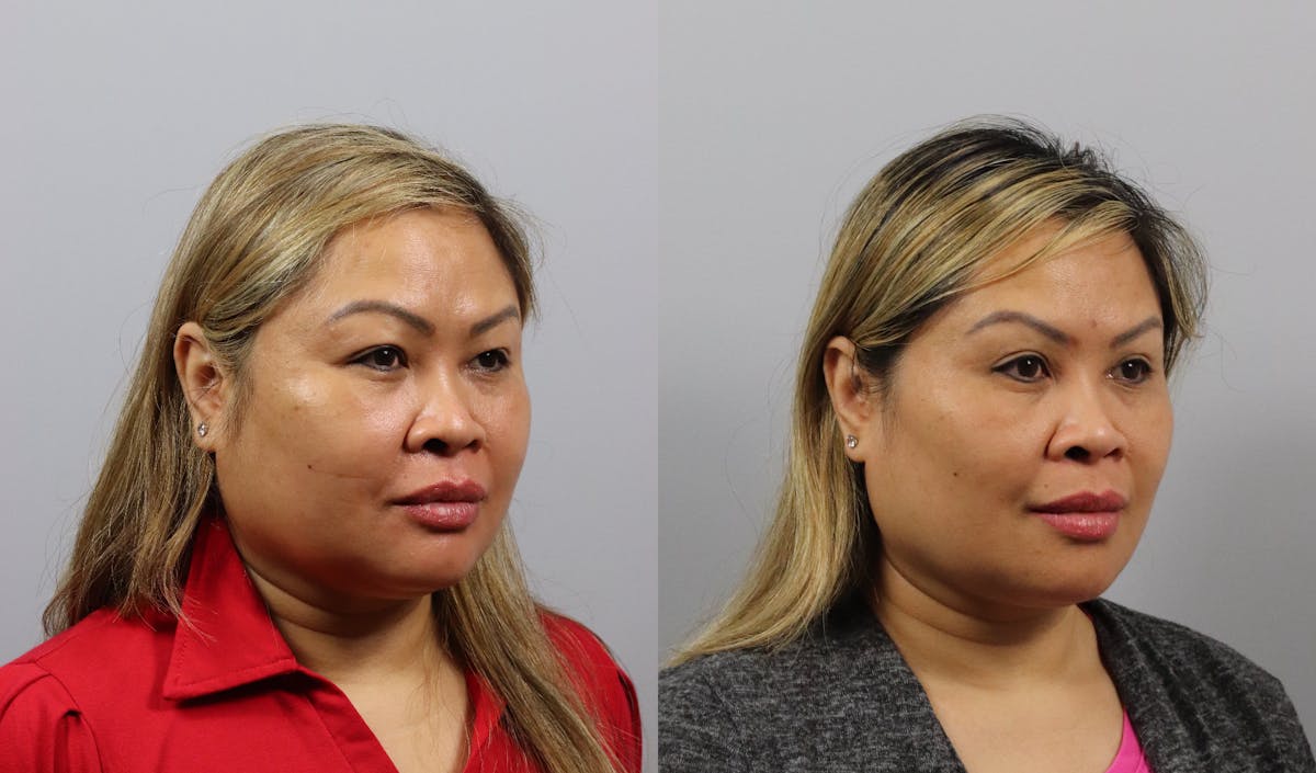 Eyelid Lift/Blepharoplasty Before & After Gallery - Patient 365138 - Image 2