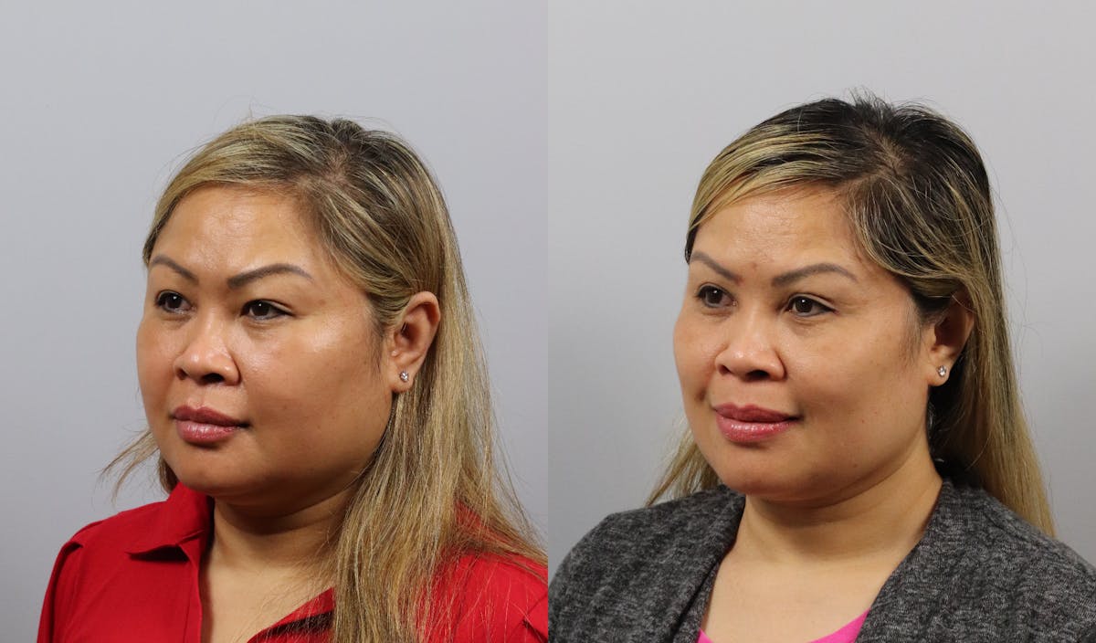 Eyelid Lift/Blepharoplasty Before & After Gallery - Patient 365138 - Image 3