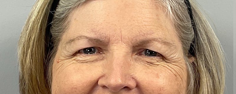 Eyelid Lift/Blepharoplasty Before & After Gallery - Patient 292856 - Image 1