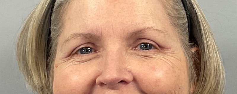 Eyelid Lift/Blepharoplasty Before & After Gallery - Patient 292856 - Image 2