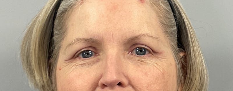 Eyelid Lift/Blepharoplasty Before & After Gallery - Patient 292856 - Image 4