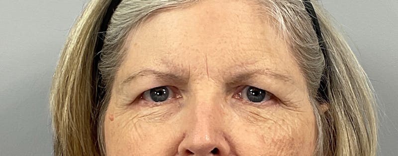Eyelid Lift/Blepharoplasty Before & After Gallery - Patient 292856 - Image 3