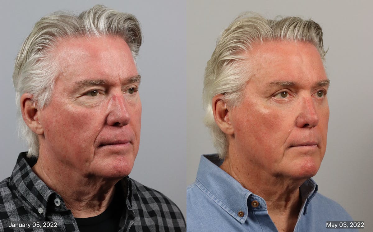 Eyelid Lift/Blepharoplasty Before & After Gallery - Patient 285033 - Image 1