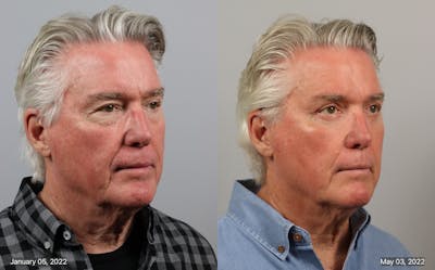 Eyelid Lift/Blepharoplasty Before & After Gallery - Patient 285033 - Image 1