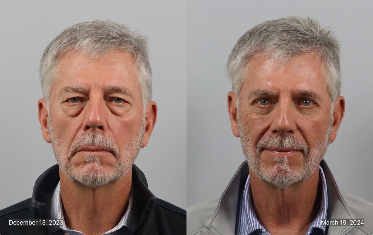 Eyelid Lift/Blepharoplasty Before & After Gallery - Patient 381441 - Image 1