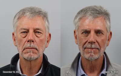 Eyelid Lift/Blepharoplasty Before & After Gallery - Patient 381441 - Image 1