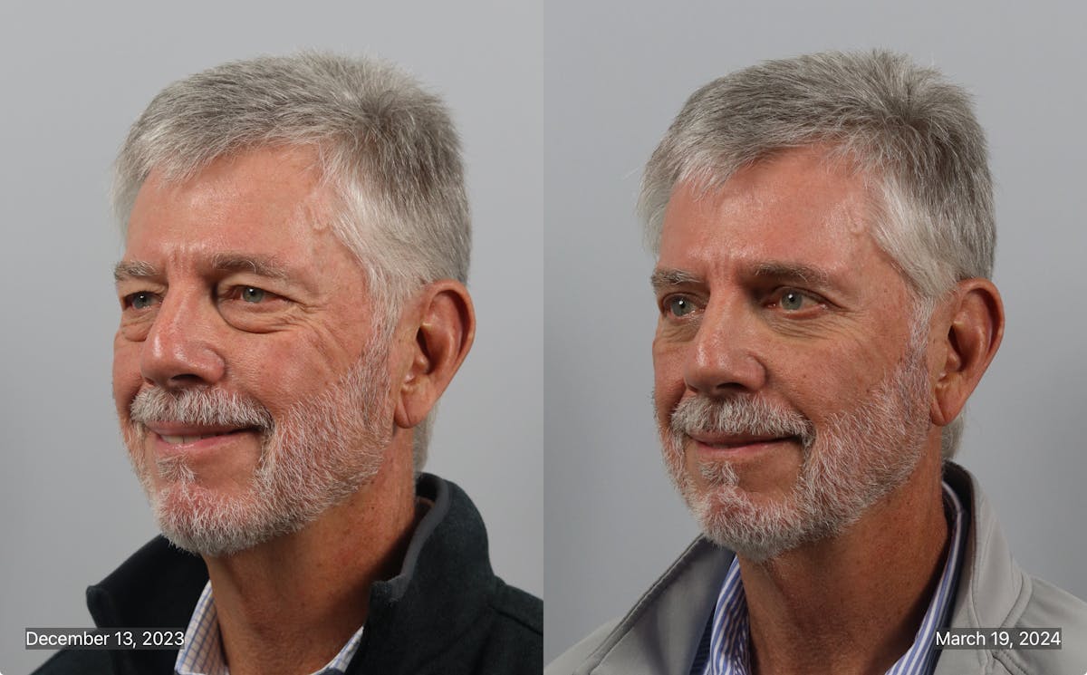 Eyelid Lift/Blepharoplasty Before & After Gallery - Patient 381441 - Image 2