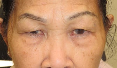 Eyelid Lift/Blepharoplasty Before & After Gallery - Patient 380328 - Image 1