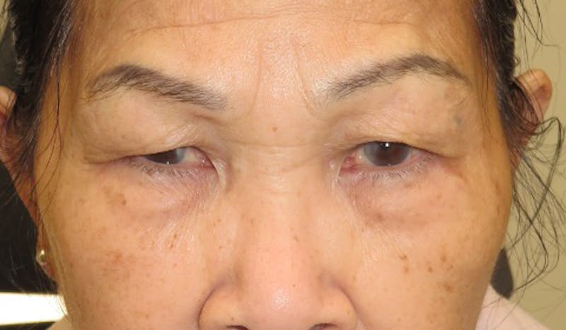Eyelid Lift/Blepharoplasty Before & After Gallery - Patient 380328 - Image 1