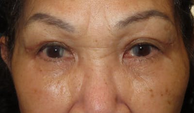 Eyelid Lift/Blepharoplasty Before & After Gallery - Patient 380328 - Image 2