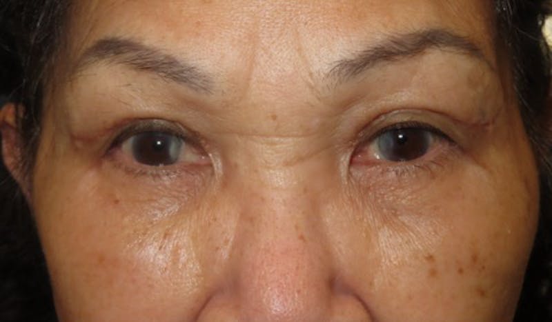 Eyelid Lift/Blepharoplasty Before & After Gallery - Patient 380328 - Image 2