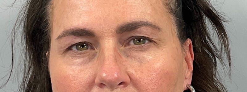 Eyelid Lift/Blepharoplasty Before & After Gallery - Patient 126475 - Image 1