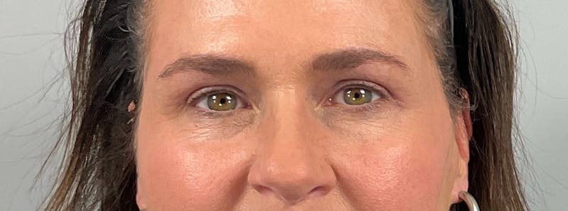 Eyelid Lift/Blepharoplasty Before & After Gallery - Patient 126475 - Image 2