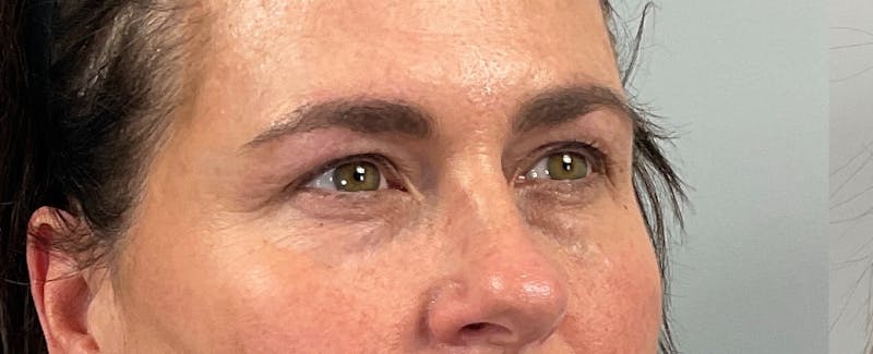 Eyelid Lift/Blepharoplasty Before & After Gallery - Patient 126475 - Image 3