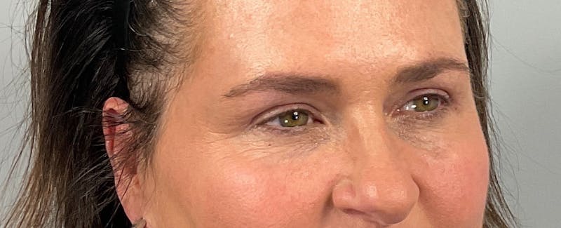 Eyelid Lift/Blepharoplasty Before & After Gallery - Patient 126475 - Image 4