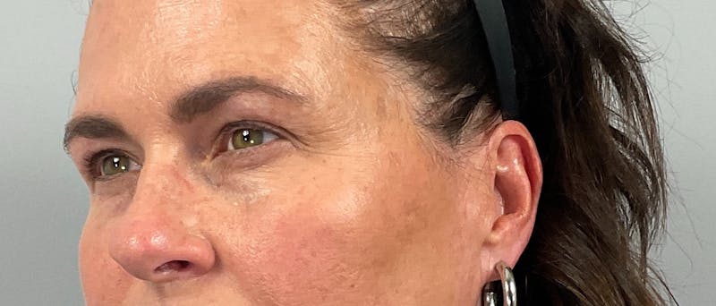 Eyelid Lift/Blepharoplasty Before & After Gallery - Patient 126475 - Image 5