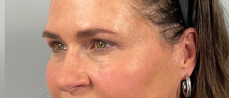 Eyelid Lift/Blepharoplasty Before & After Gallery - Patient 126475 - Image 6