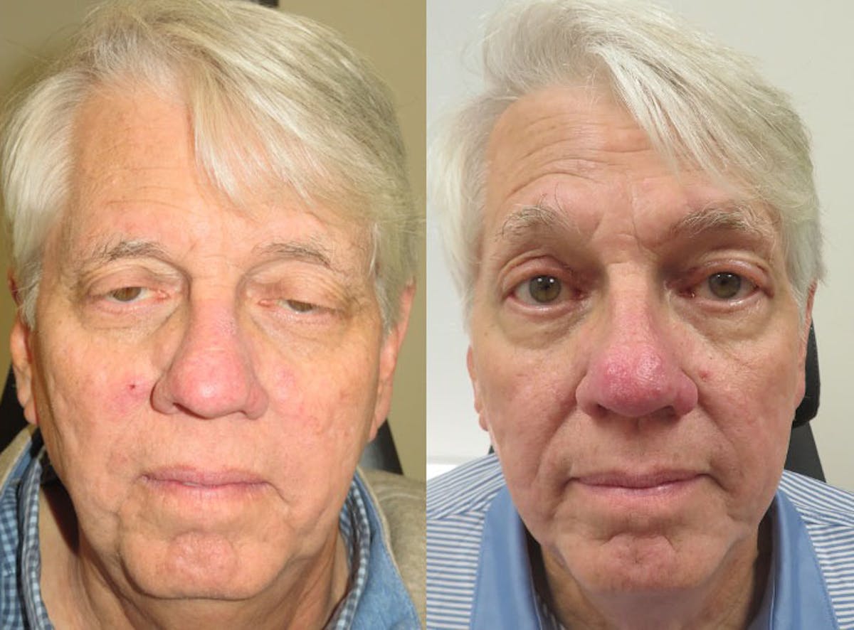 Eyelid Ptosis Repair Before & After Gallery - Patient 206075 - Image 1