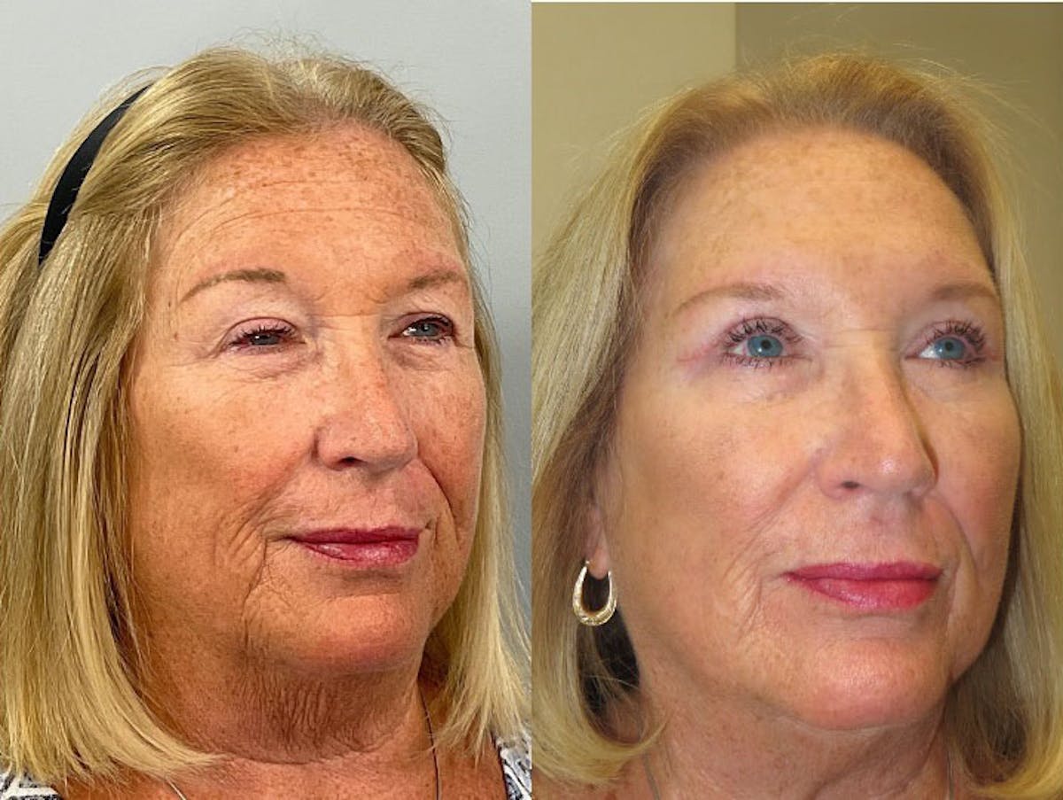 Eyelid Ptosis Repair Before & After Gallery - Patient 377122 - Image 3