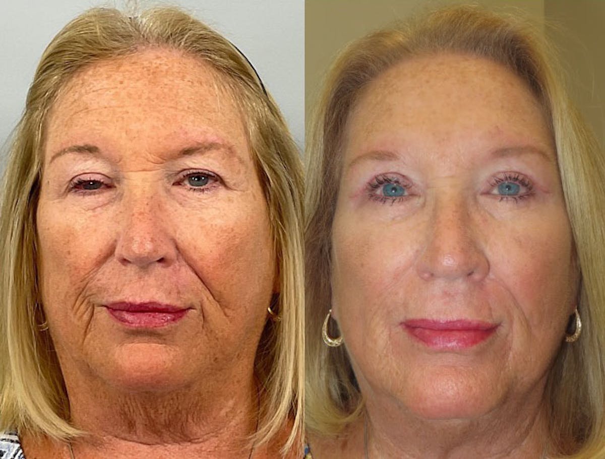 Eyelid Ptosis Repair Before & After Gallery - Patient 377122 - Image 2