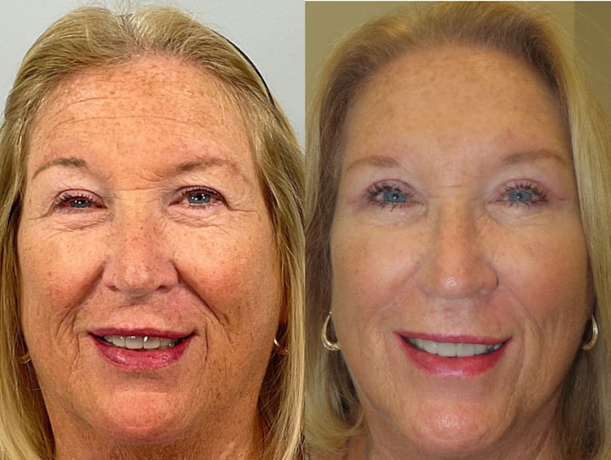 Eyelid Ptosis Repair Before & After Gallery - Patient 377122 - Image 1