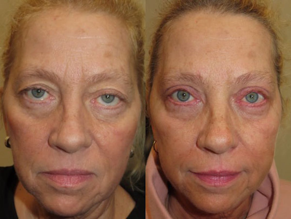 Eyelid Ptosis Repair Before & After Gallery - Patient 350200 - Image 1