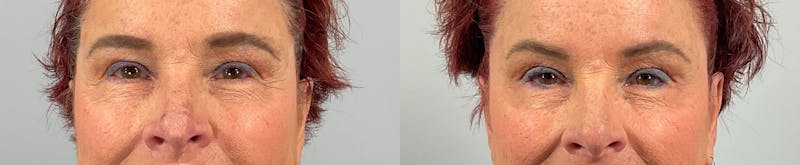 BOTOX Before & After Gallery - Patient 635661 - Image 2