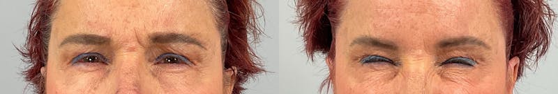 BOTOX Before & After Gallery - Patient 635661 - Image 3