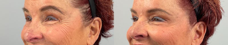 BOTOX Before & After Gallery - Patient 635661 - Image 1