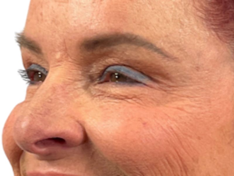 BOTOX Before & After Gallery - Patient 635661 - Image 4